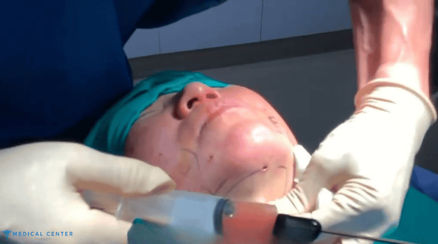 Jowl Liposuction in 2025