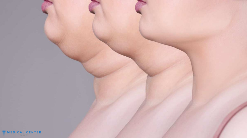 Why Jowl Liposuction is Gaining Popularity in 2025