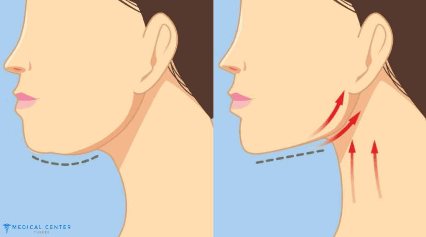 Why Jowl Liposuction is Gaining Popularity in 2025