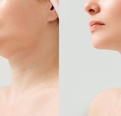 Why Jowl Liposuction is Gaining Popularity in 2025?