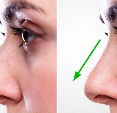 What Are the Differences Between Rhinoplasty Options in 2025?