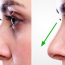 What Are the Differences Between Rhinoplasty Options in 2025?