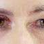 Say Goodbye to Droopy Eyelids with Eye Lift in Turkey
