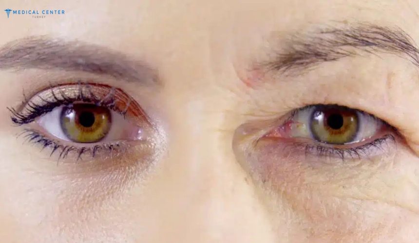 Say Goodbye to Droopy Eyelids with Eye Lift in Turkey