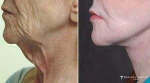 Everything You Should Know About a Neck Lift in 2025