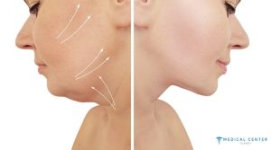Everything You Should Know About a Neck Lift in 2025