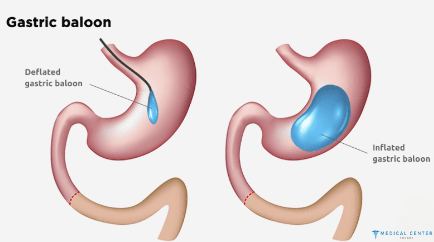Gastric Balloon Surgery in 2025