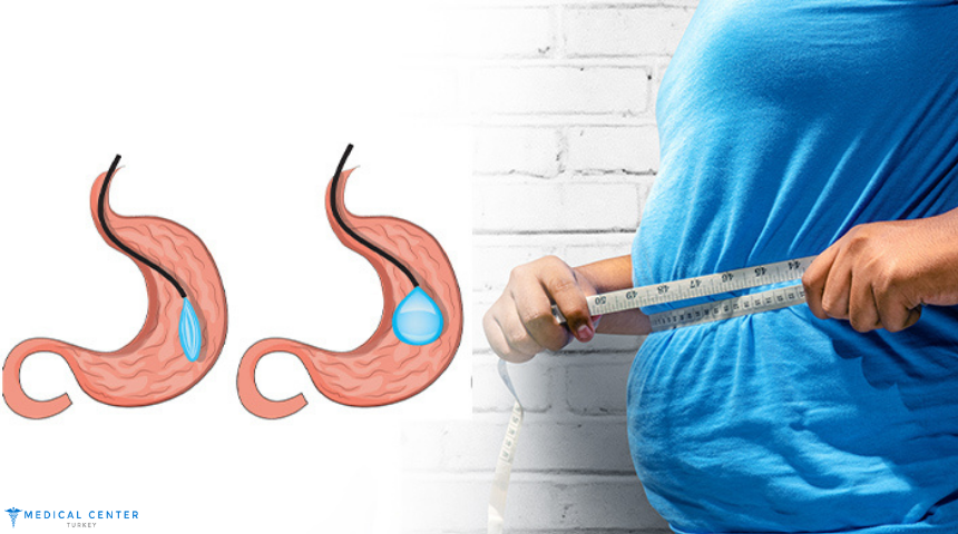 Gastric Balloon Surgery in 2025