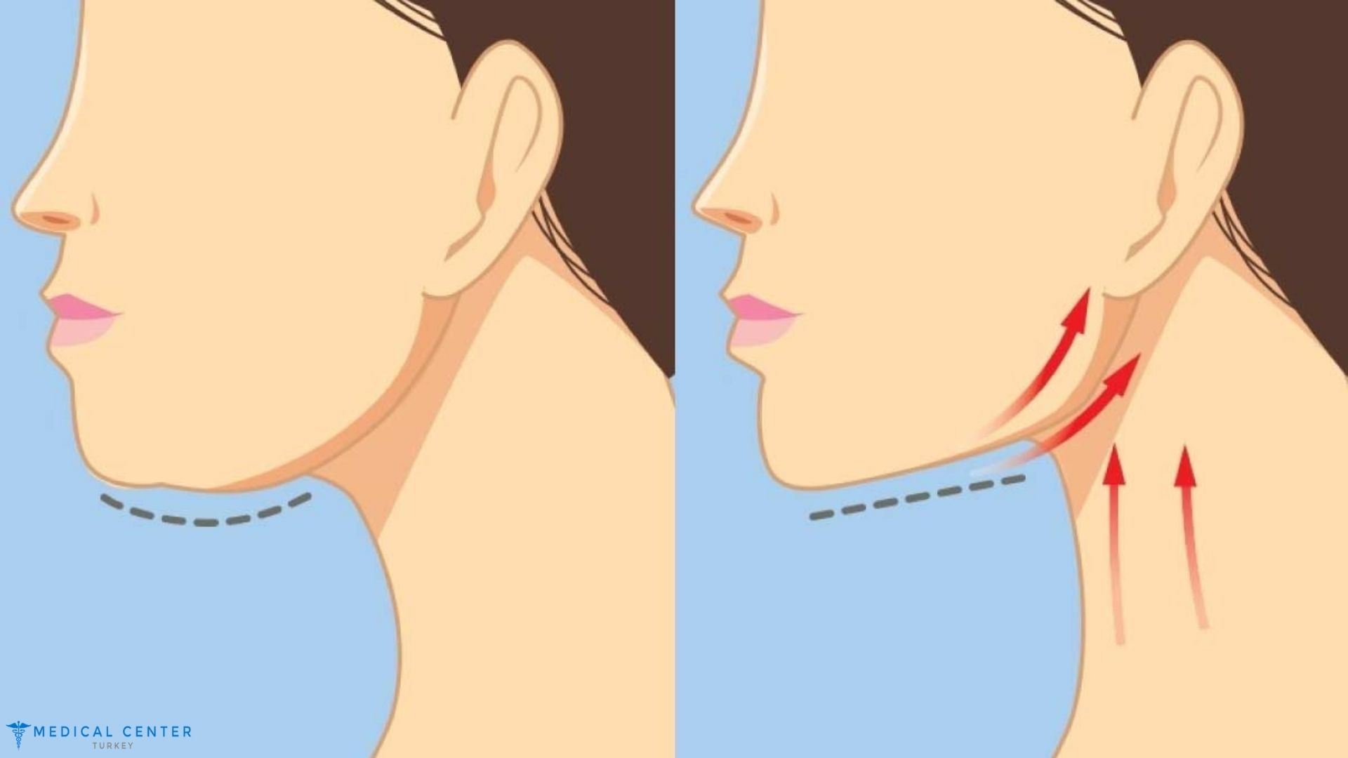 Jowl Liposuction in 2025