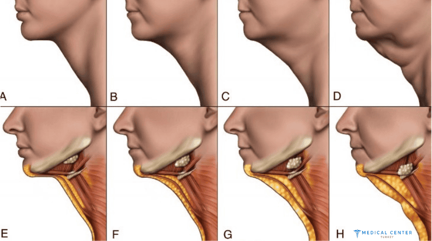 Neck Lift Surgery: A 2025 Solution for a Youthful Neckline