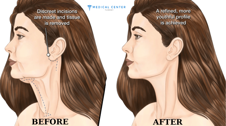 Neck Lift Surgery: A 2025 Solution for a Youthful Neckline