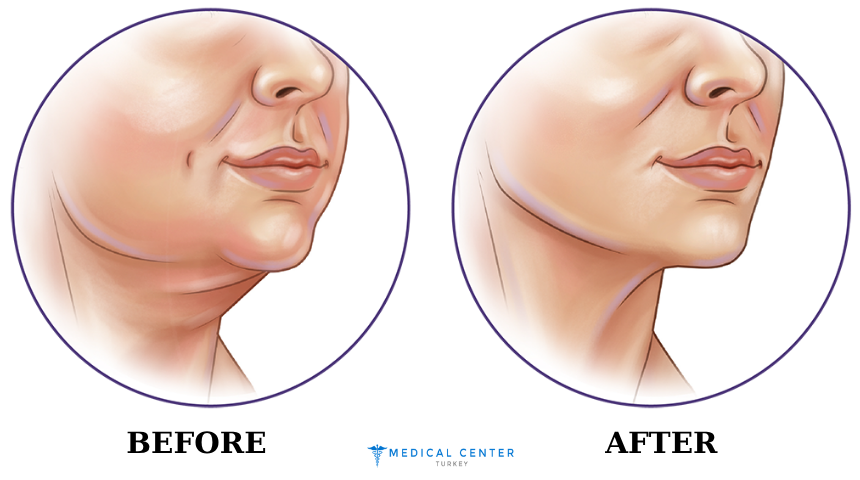Neck Lift Surgery: A 2025 Solution for a Youthful Neckline