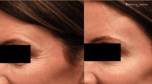 Is Botox Worth it in Turkey?