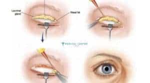 Say Goodbye to Droopy Eyelids with Eye Lift in Turkey