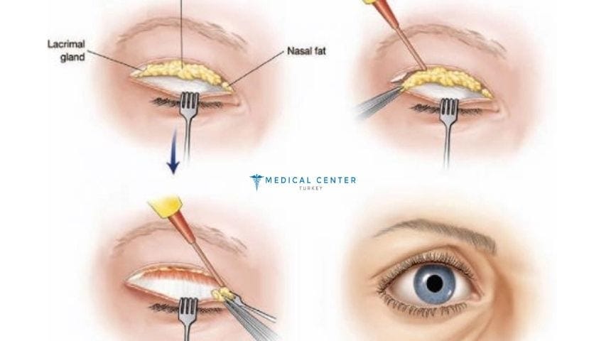Say Goodbye to Droopy Eyelids with Eye Lift in Turkey 
