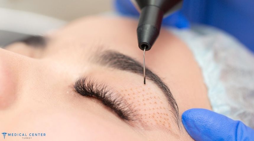Say Goodbye to Droopy Eyelids with Eye Lift in Turkey