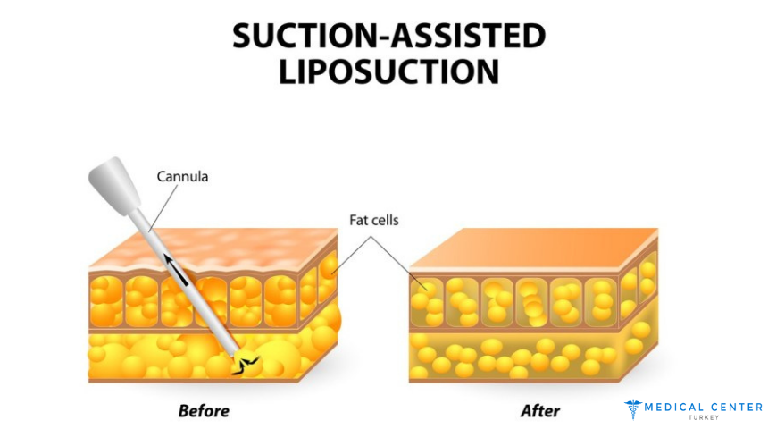 Simple Guide to Liposuction in Turkey 2025