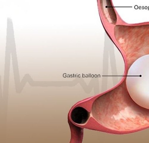 Gastric Balloon Surgery in 2025 Gastric Balloon Surgery in 2025