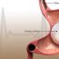 Gastric Balloon Surgery in 2025