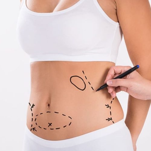 Simple Guide to Liposuction in Turkey 2025