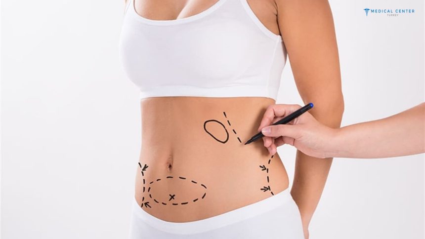 Simple Guide to Liposuction in Turkey 2025