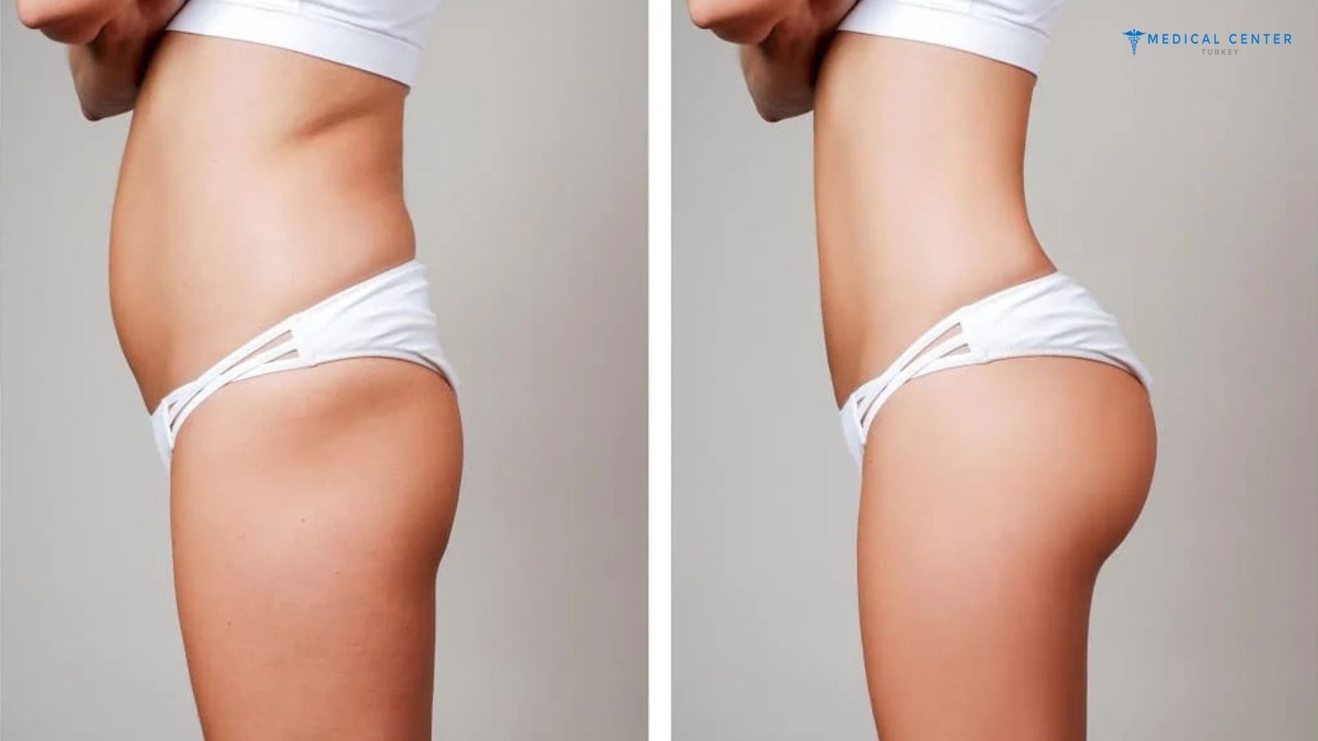 Hip Lift Surgery in Turkey 2025