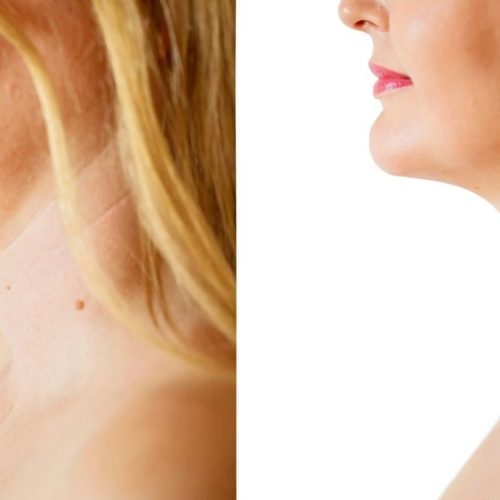 Jowl Liposuction in Turkey