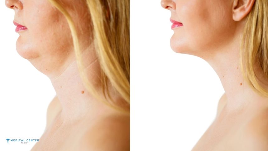 Jowl Liposuction in Turkey