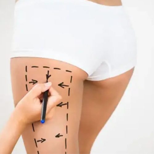 Hip Lift Surgery in Turkey 2025 Hip Lift Surgery in Turkey 2025