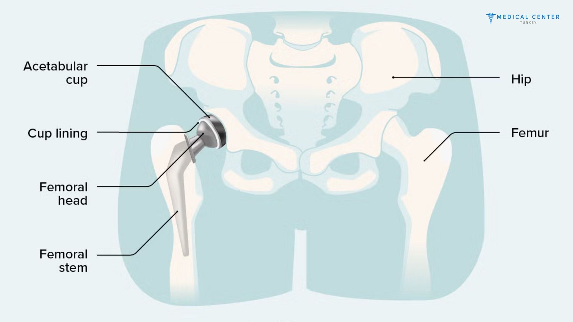 Hip Lift Surgery in Turkey 2025
