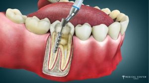 Is Dental Treatment in Turkey Reliable in 2025?