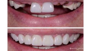 Is Dental Treatment in Turkey Reliable in 2025?