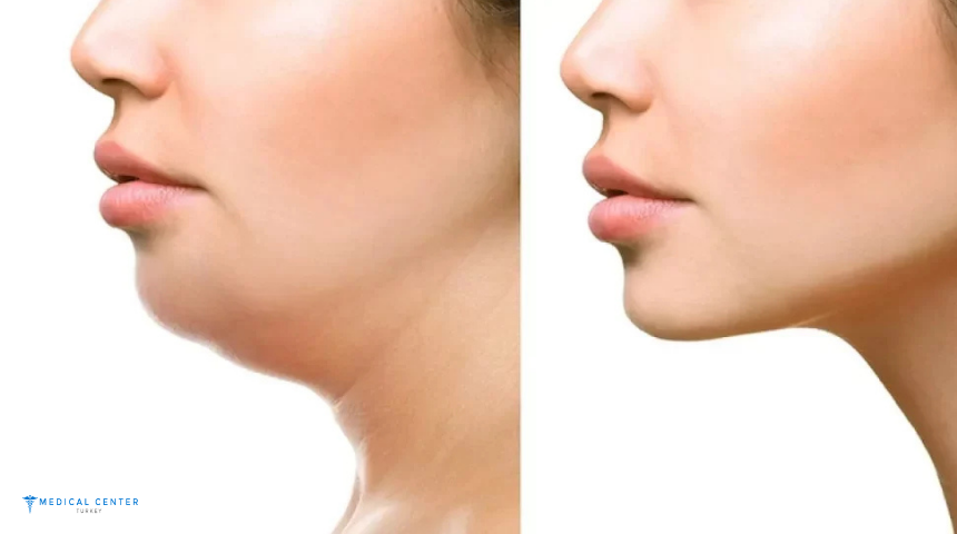 Jowl Liposuction in 2025 Jowl Liposuction in 2025