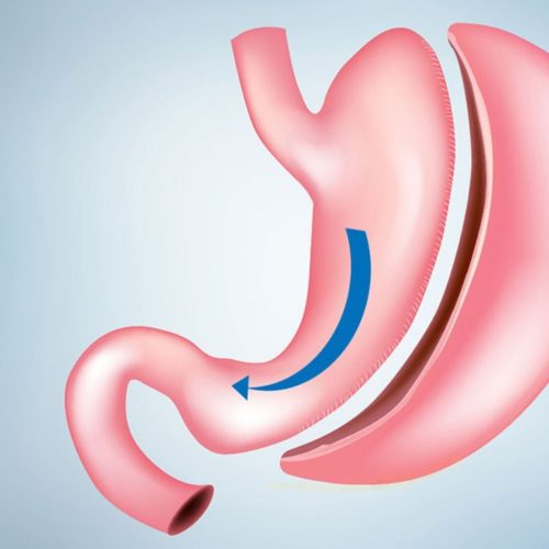 How Safe Is Gastric Sleeve Surgery in Turkey?
