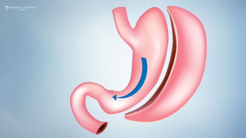 How Safe Is Gastric Sleeve Surgery in Turkey?