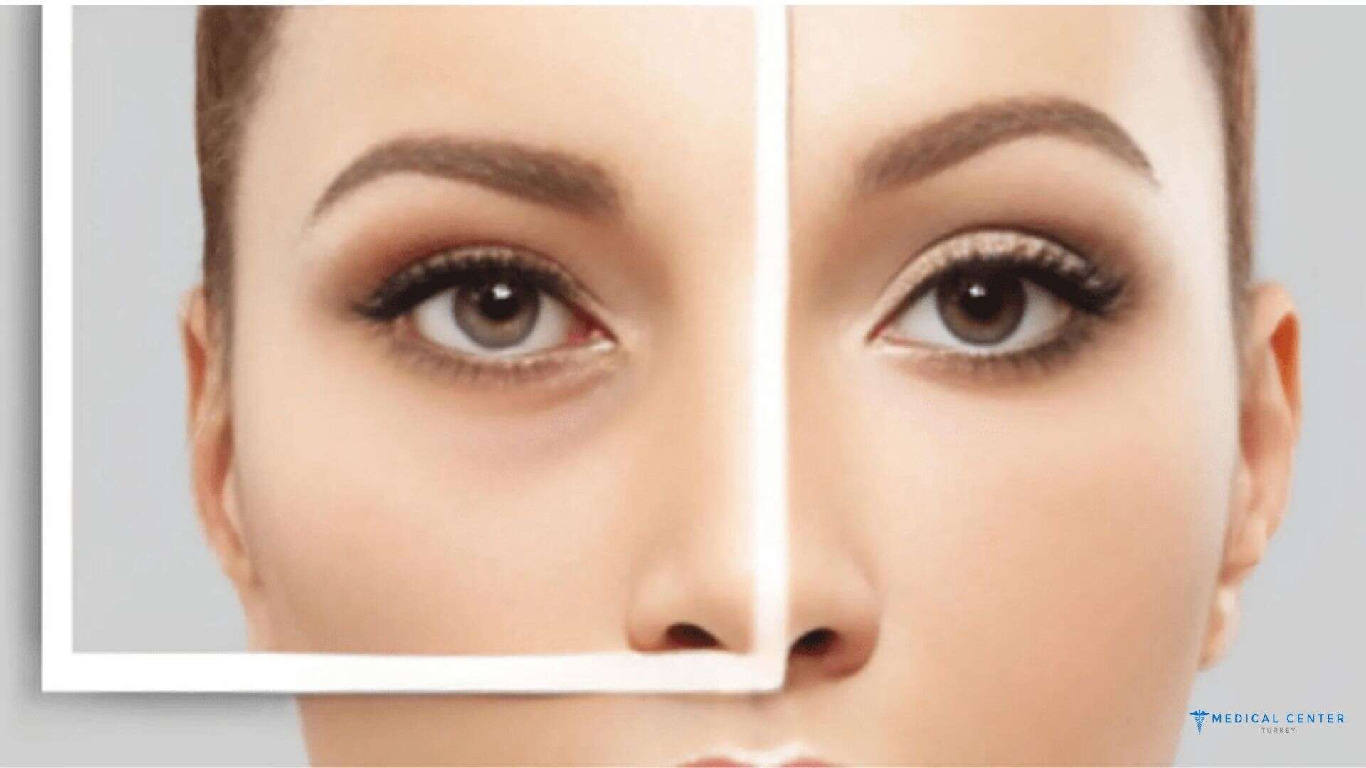 What Eye Surgeries Are Offered in Turkey in 2026?