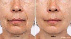 How Much Does Fat Transfer to Face Cost in Turkey 2025?