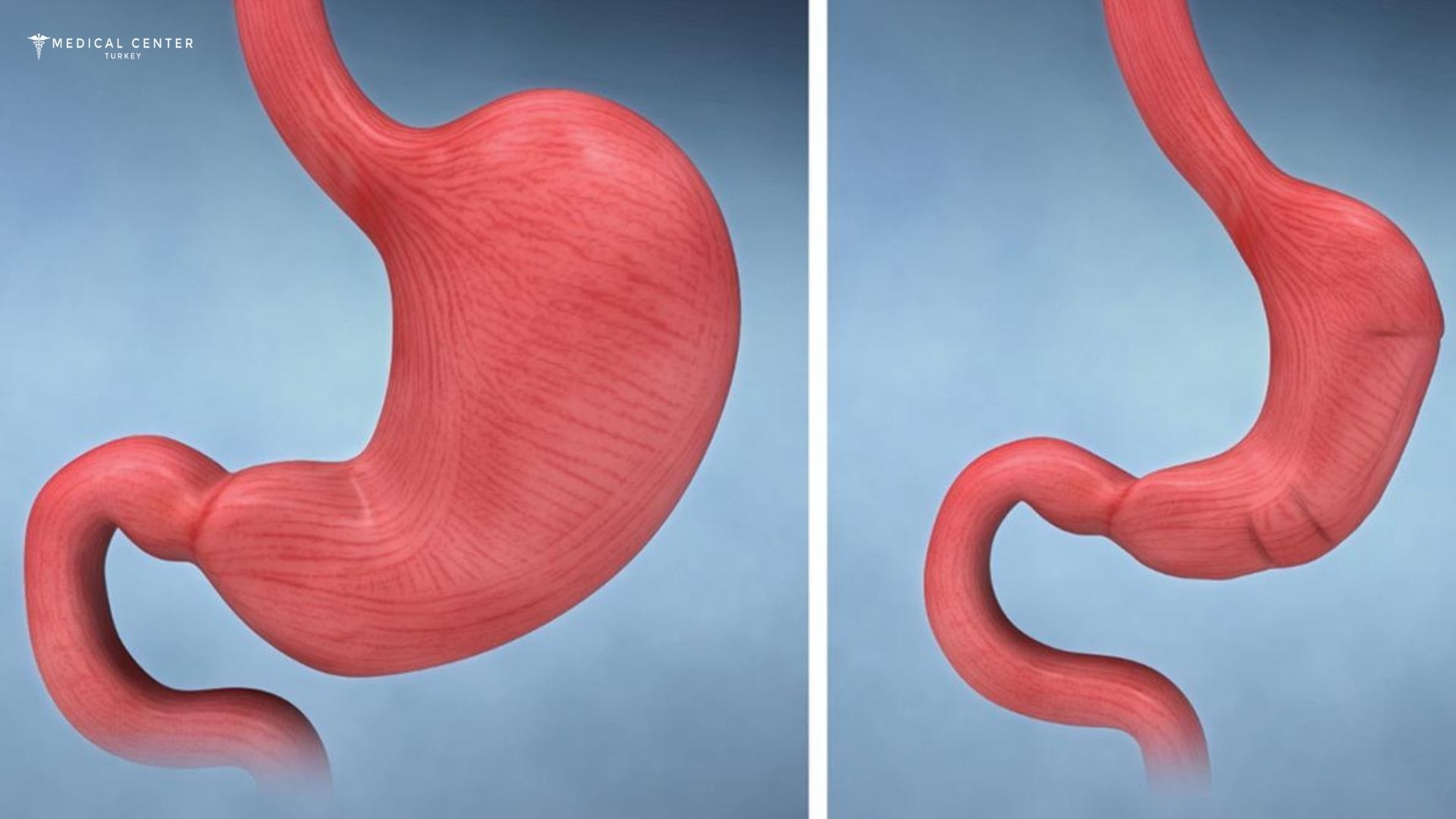 How Safe Is Gastric Sleeve Surgery in Turkey?