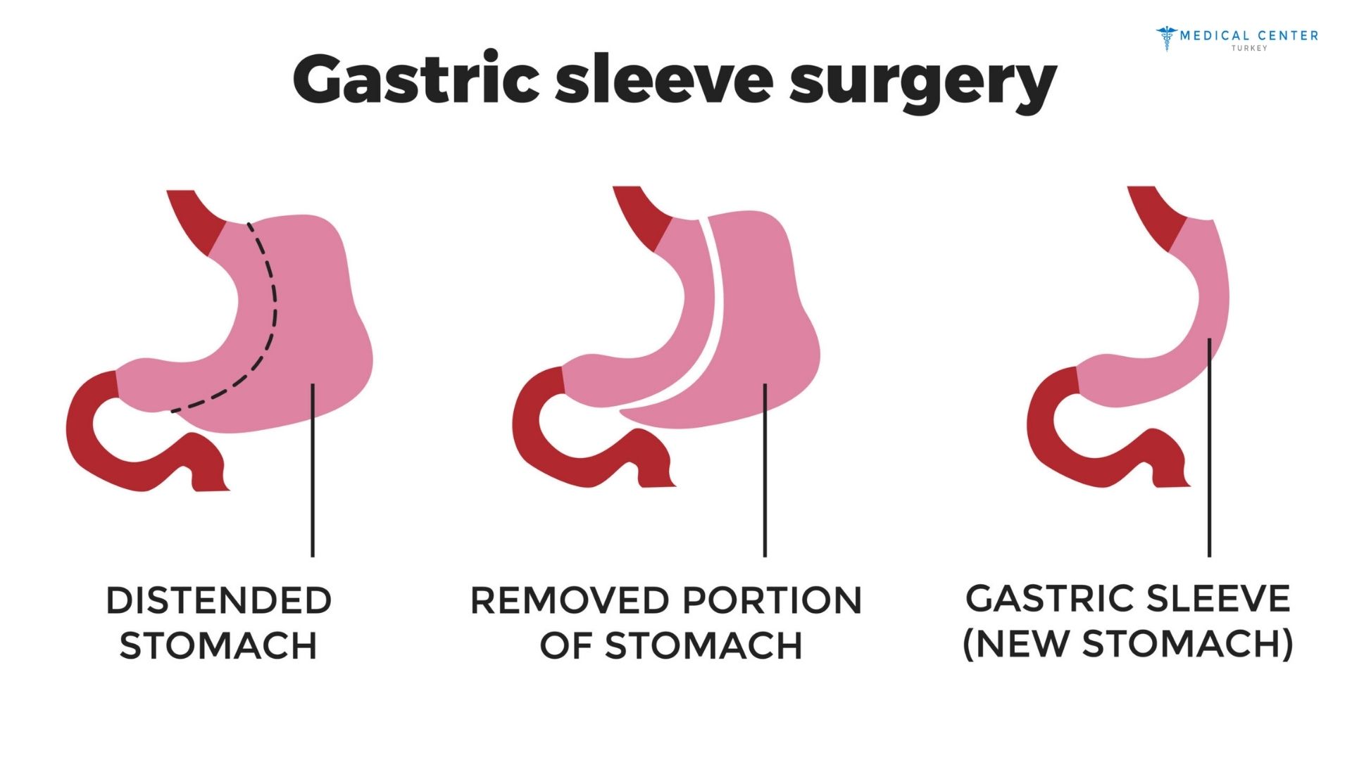 How Safe Is Gastric Sleeve Surgery in Turkey?