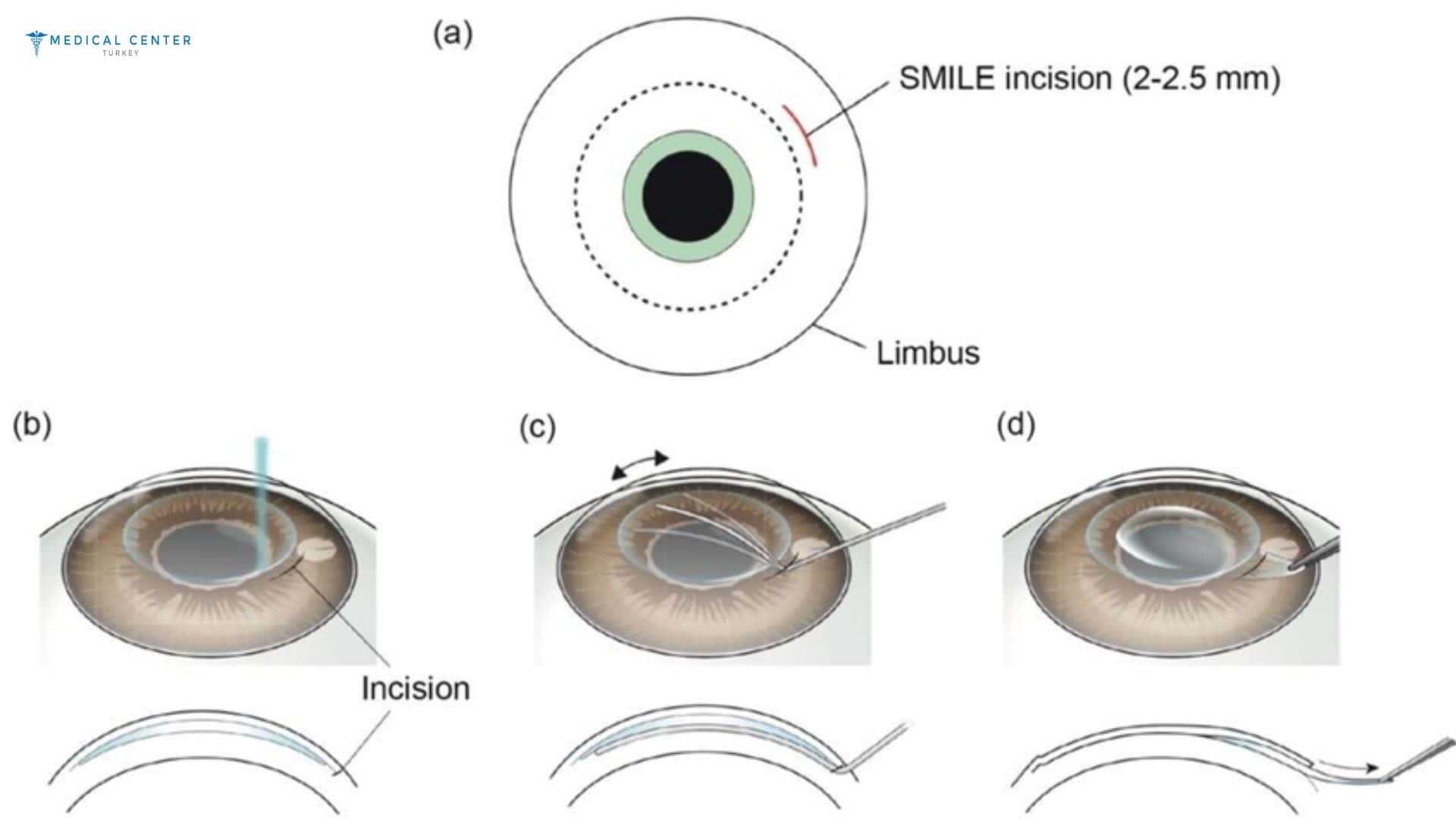 What Eye Surgeries Are Offered in Turkey in 2026?
