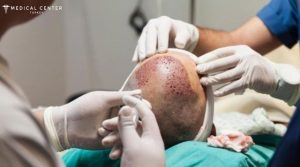 How Long Do Hair Transplants Last in Turkey ?