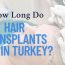 How Long Do Hair Transplants Last in Turkey?