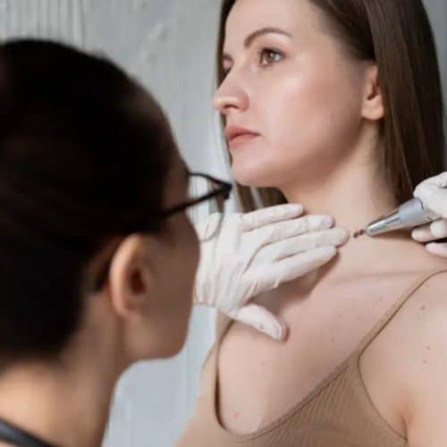 Is Mole Removal in Turkey Safe and Affordable?