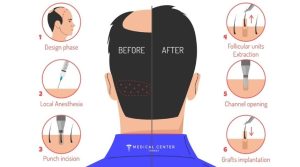 How Long Do Hair Transplants Last in Turkey ?