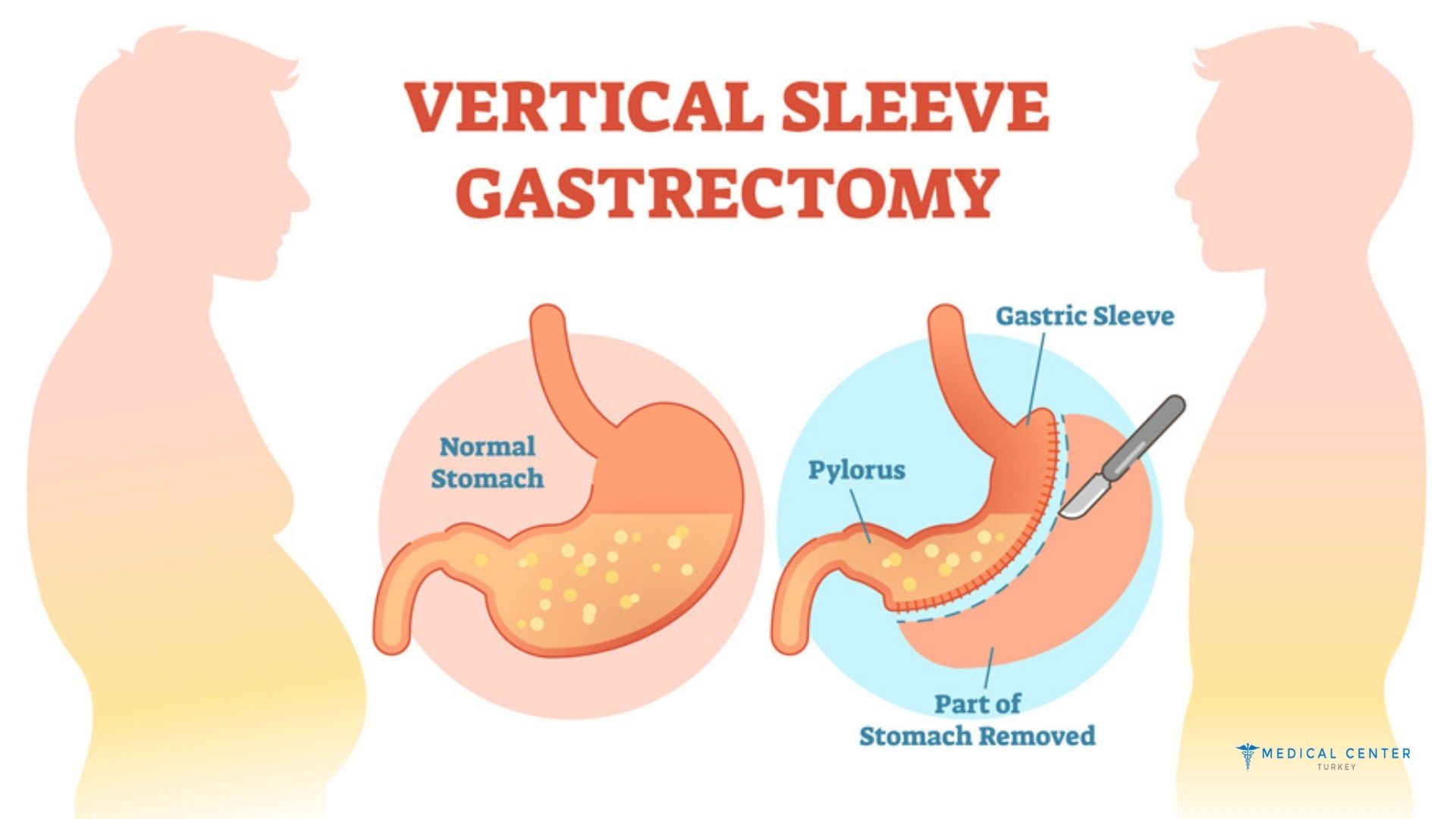 How Safe Is Gastric Sleeve Surgery in Turkey?
