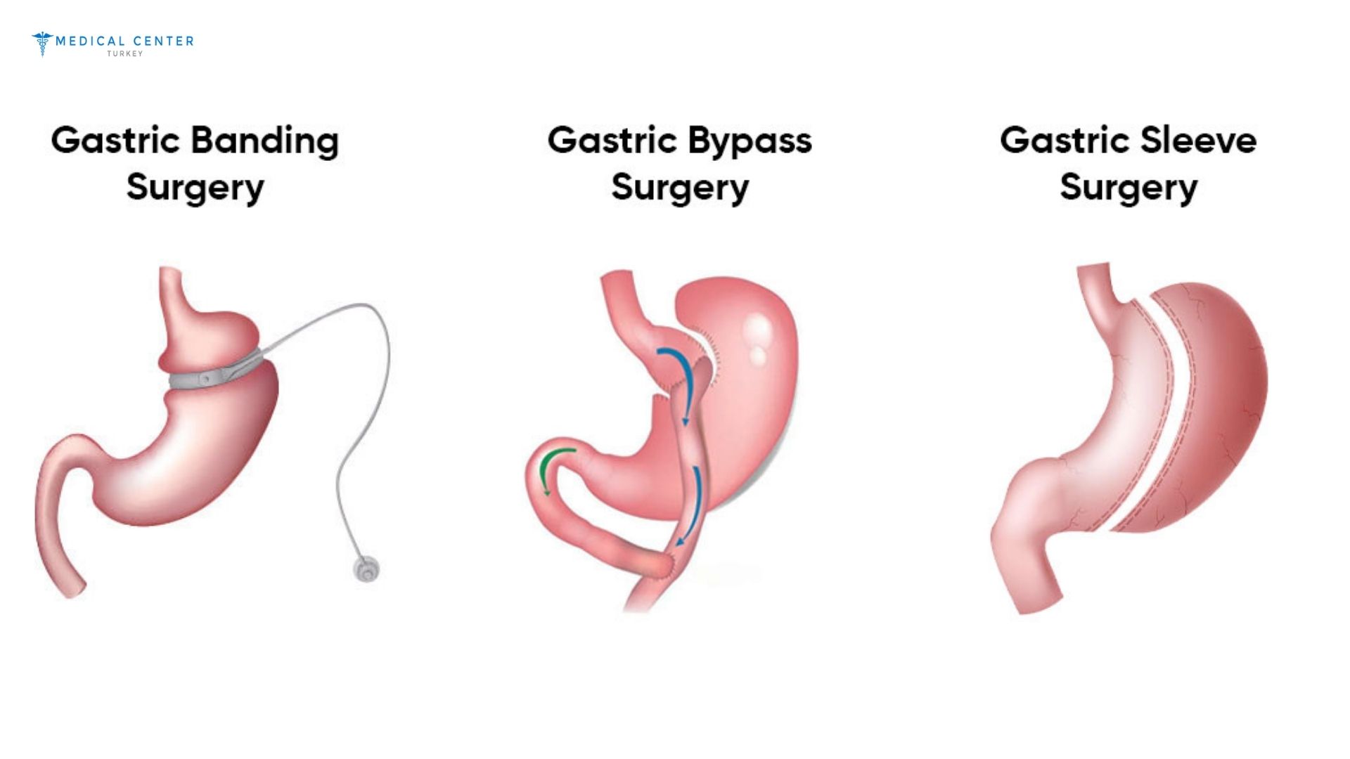 How Safe Is Gastric Sleeve Surgery in Turkey?