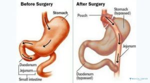 Are Bariatric Surgeries Popular Among Medical Tourists in 2025?