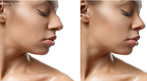 Why Choose Turkey For a Nose Job in 2025 ?