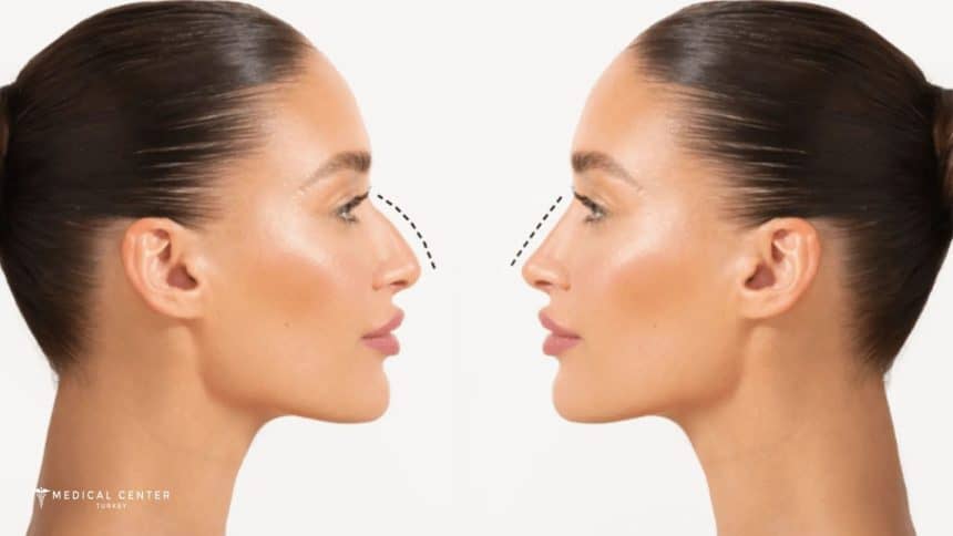 Why Choose Turkey For a Nose Job?