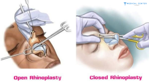 Why Choose Turkey For a Nose Job in 2025 ?